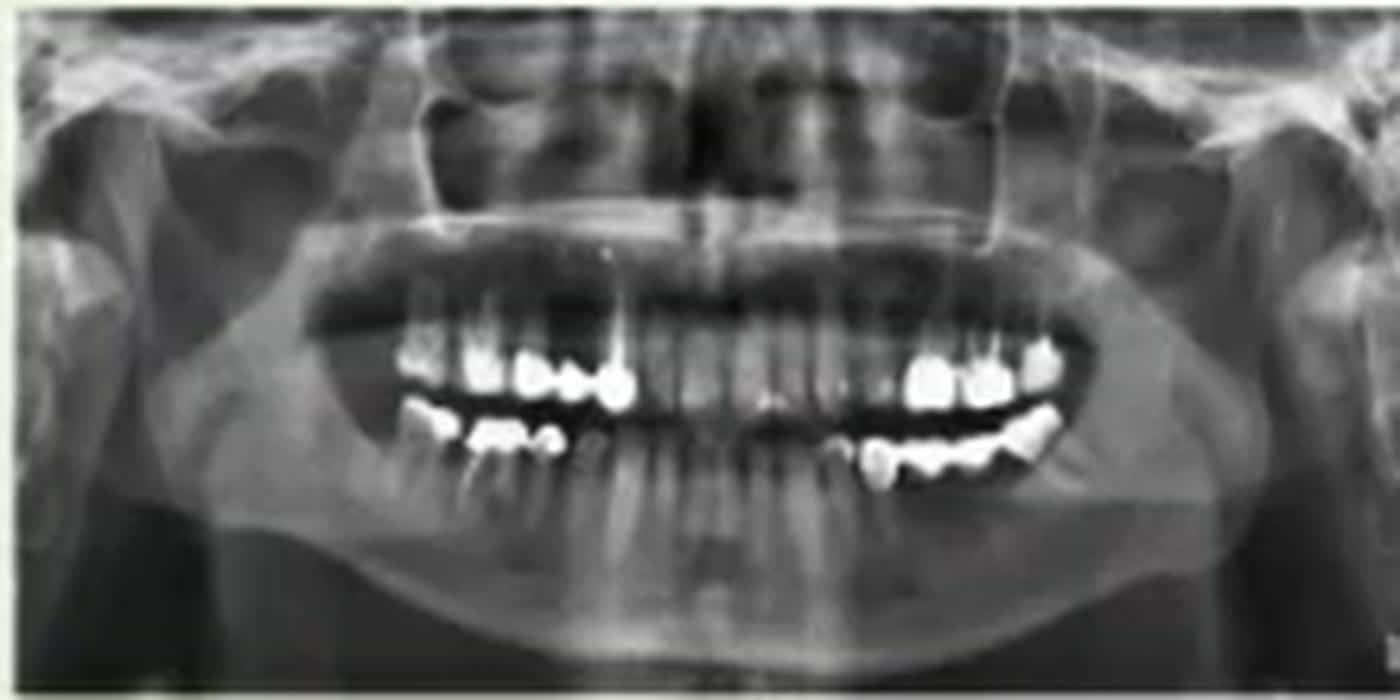 Pantomogram 1