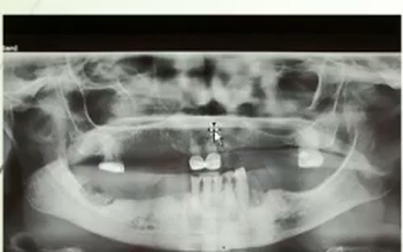Pantomogram 1