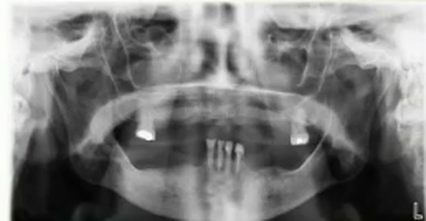 Pantomogram 2