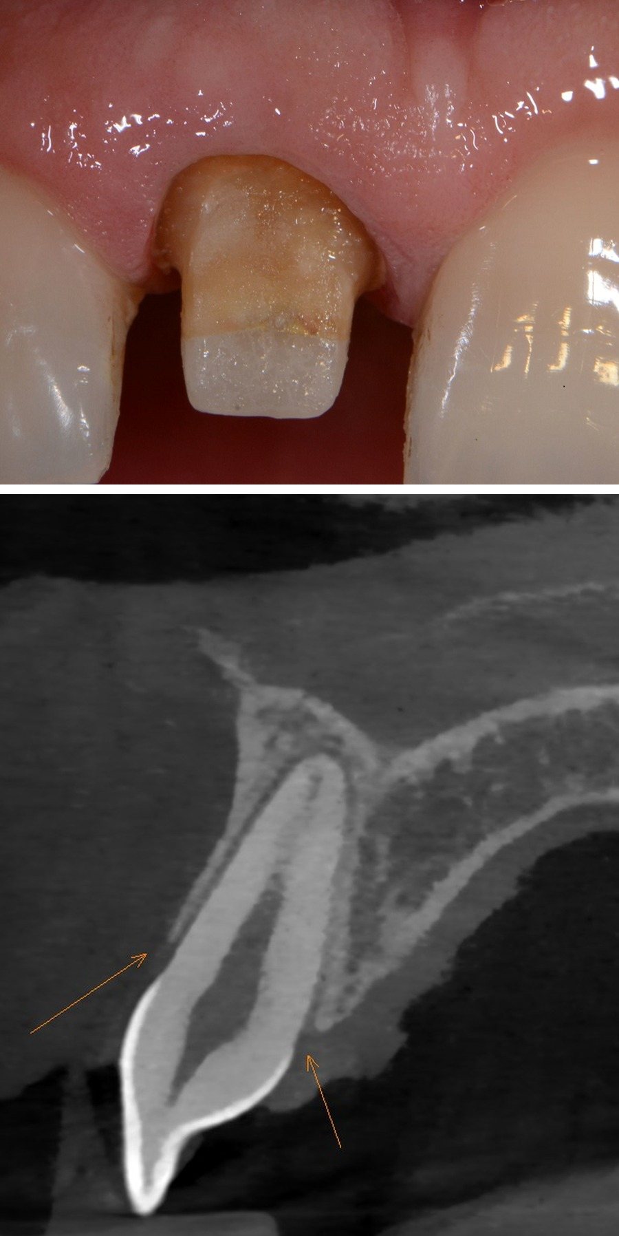 Obraz kliniczny i przekrój CBCT – slajd 5 prezentacji dr n. med. Emilii Klein-Dębek