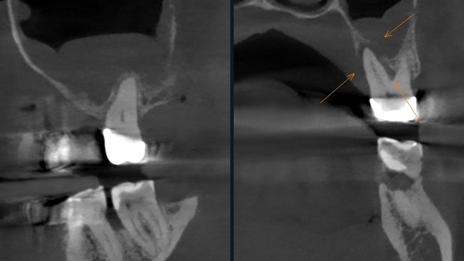 Przekroje CBCT ze slajdu 7 prezentacji dr n. med. Emilii Klein-Dębek
