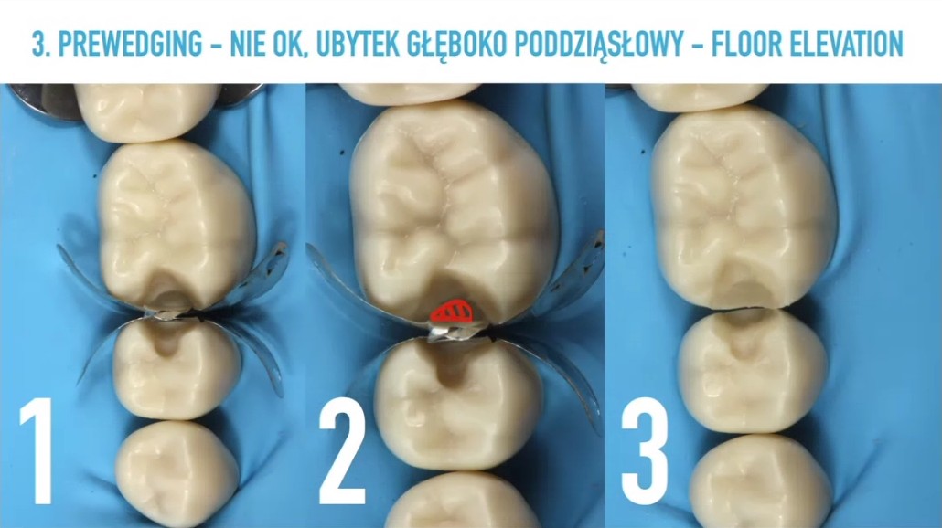 Kadr z nagrania: Głęboki ubytek klasy II: klin wchodzi w światło ubytku
